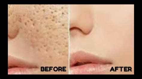 How To Shrink Reducelarge Open Pores And Tighten Skin Permanently