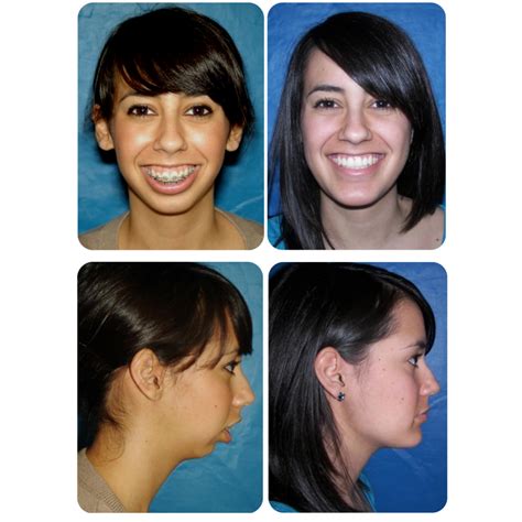 Before And After Photos Maxillofacial Surgery Larry M Wolford Dmd