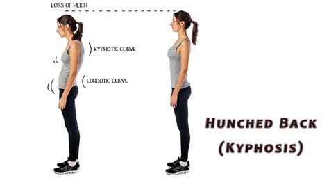 Hunched Back Kyphosis Orthopaedic Spine Surgery Singapore