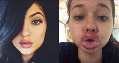 The Kylie Jenner Lip Challenge Has Turned Into A Complete Disaster