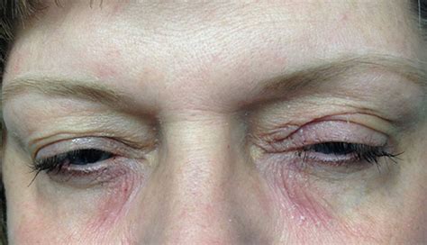 What Causes Rashes On Eyelids