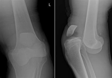 Anterior Knee Dislocation Radiology At St Vincent S University Hospital