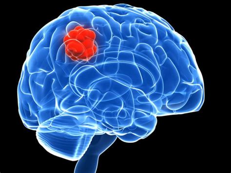 The most common of these tumors is diffuse intrinsic pontine. Heres Why Childhood Brain Tumour Survivors Can Be Prone to ...