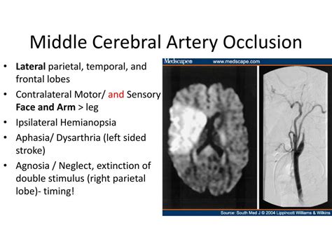 Evaluation Of The Middle Cerebral Artery Occlusion Techniques In The My Xxx Hot Girl