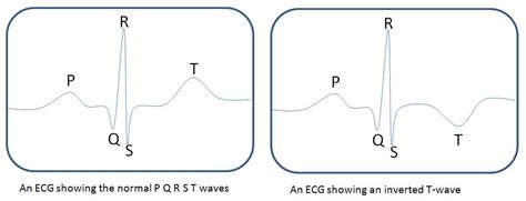 Fileschematic Ecg Normal And Inverted T Wave Embryology