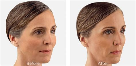 Juvéderm Fillers At Vedas Medical Spa And Wellness Center