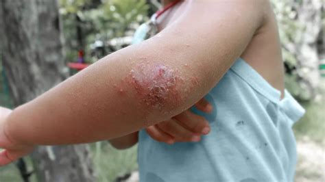 Dermatitis Eczema Pruritus Ointment For Children Adults Natural