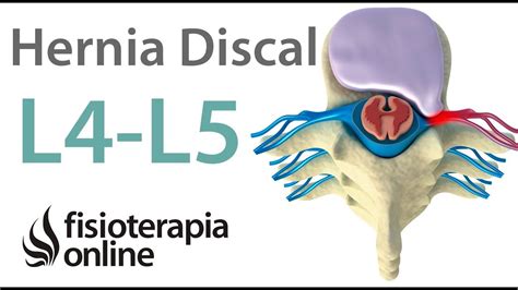Hernia Discal Lumbar Entre La L4 Y L5 O Cuarta Y Quinta Vértebras