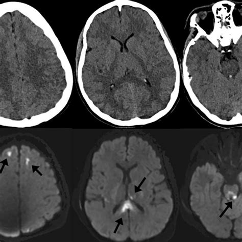 Noncontrast Computed Tomography Ct Of The Head Top Row And