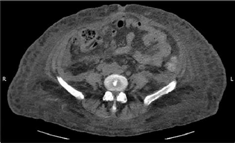 Abdominal Ct Scan Showing Complete Resolution Of Rectus Sheath And