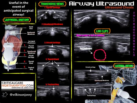 Airway Ultrasound Pocus Cheats Airway Ultrasound Grepmed