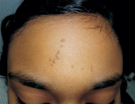 Linear Hyperkeratotic Papules On The Forehead