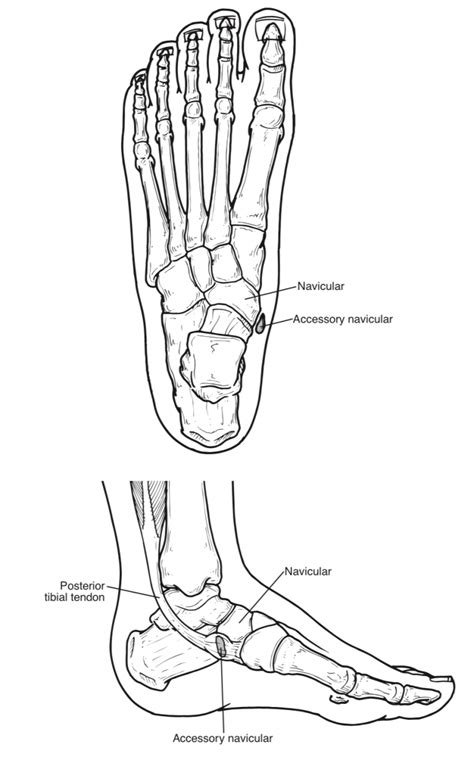 Accessory Navicular Syndrome San Mateo Podiatry Group