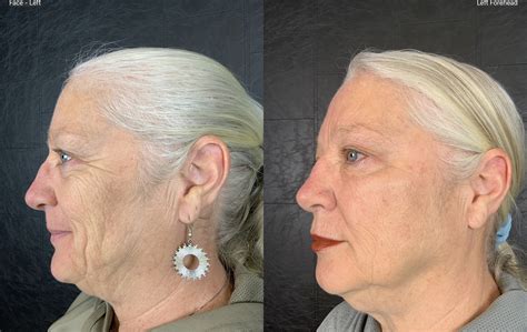 Y Lift Before And After 13 Bella Vi