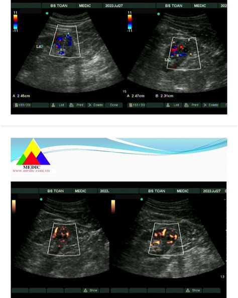 Vietnamese Medic Ultrasound Case 661 Rcc Detected In Check Up