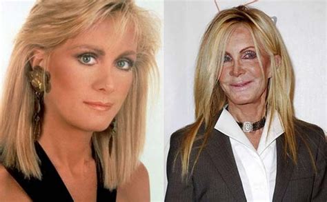 13 Shocking Celebrity Plastic Surgery Disasters Page 11 Of 14 Celebrity Plastic Surgery