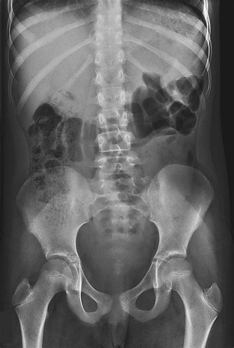 Case Challenge — A 9 Year Old Girl With Intermittent Abdominal Pain — Nejm