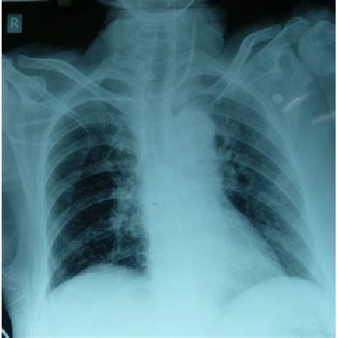 Chest X Ray Showing Malpositioned Central Venous Catheter Present In