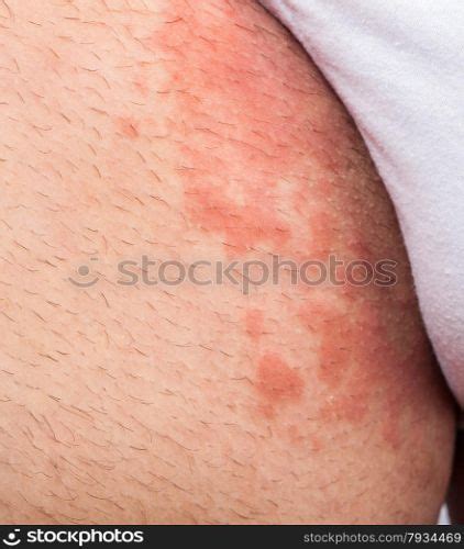 Eczema Groin Atopic Dermatitis Symptom Of Skin Texture —