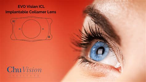 Evo Icl Implantable Contact Lenses In Minneapolis