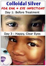 Pictures of Colloidal Silver Drops In Eyes