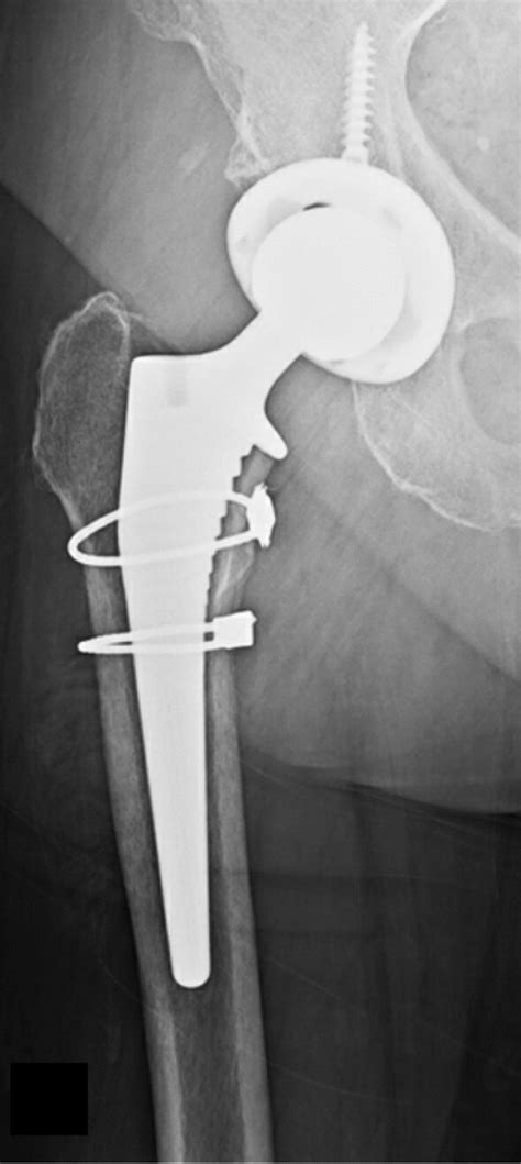 Anteroposterior Radiographs Six Week Post Total Hip Arthroplasty With