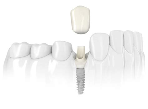 Single Tooth Replacement Dental Implants Moncton Smiles Dental Docs