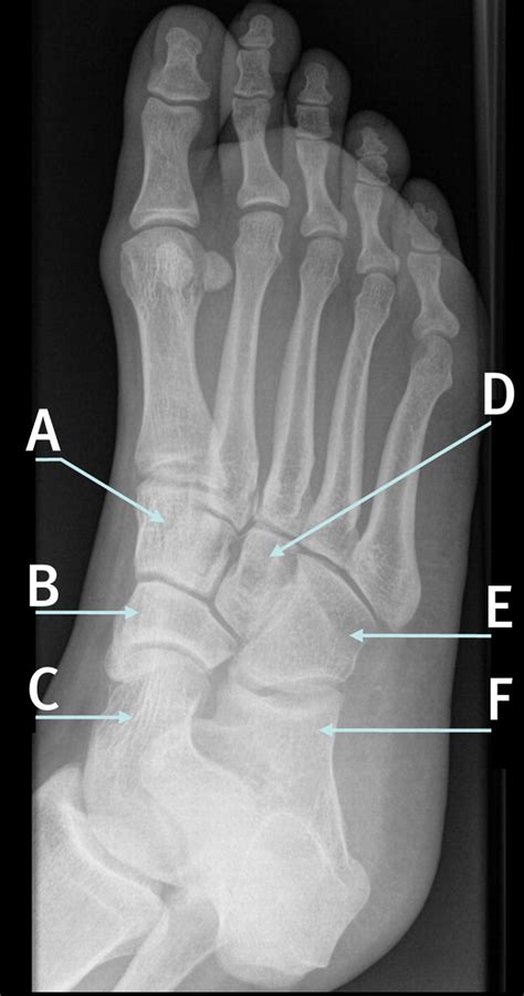 Anatomy Of The Bones Of The Foot The Bmj