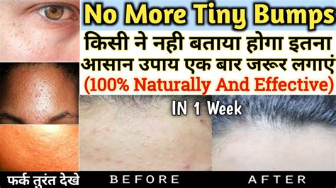 1 Week Challenge Get Rid Of Tiny Bumps 100 Naturally And Effective