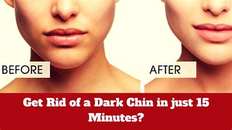 How To Get Rid Of A Dark Chin In Just 15 Minutes