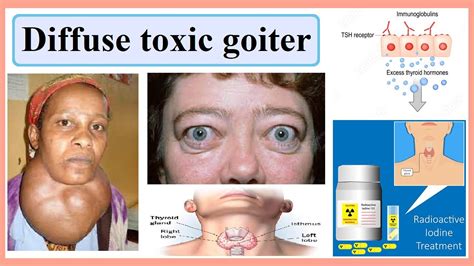 Goiter Symptoms Treatment