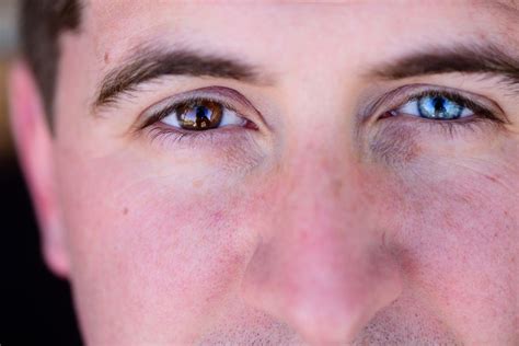 Heterochromia Symptoms Causes Diagnosis Treatment