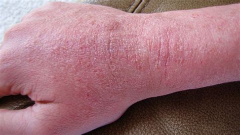 Types Of Skin Rashes And Symptoms With Pictures Beauty