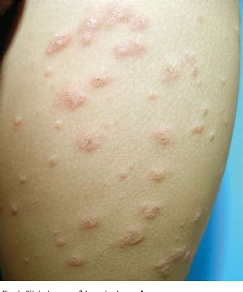 Figure 1 From Gianotti Crosti Syndrome After Hepatitis A Vaccination