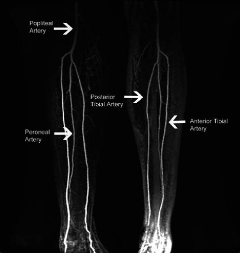 Mr Angiography Of 39 Year Old Man Shows Normal Lower Limbs Download