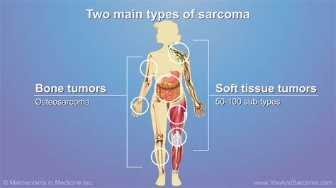 Understanding Soft Tissue Sarcoma