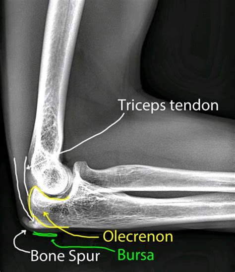 Olecrenon Bursitis Dr Michael Codsi Patient Education Michael