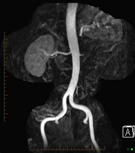 Renal Angiogram Mr Angiography Image