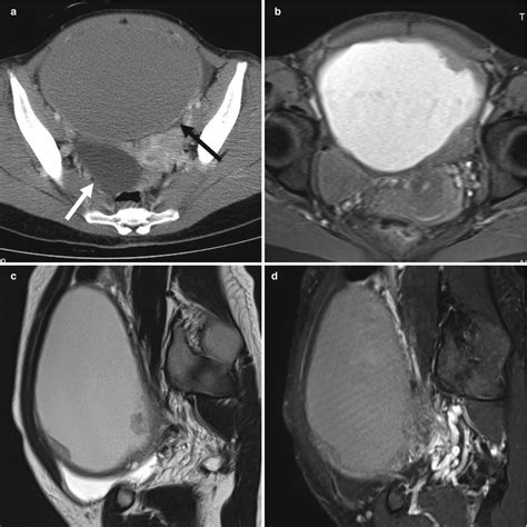Tomographic And Magnetic Resonance Imaging Of Borderline And Serous