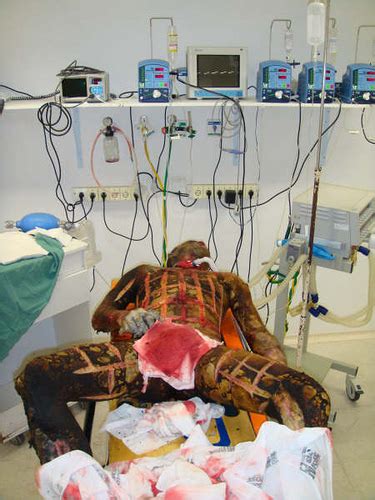 © agency for clinical innovation 2019. Deformutilation: The Escharotomy