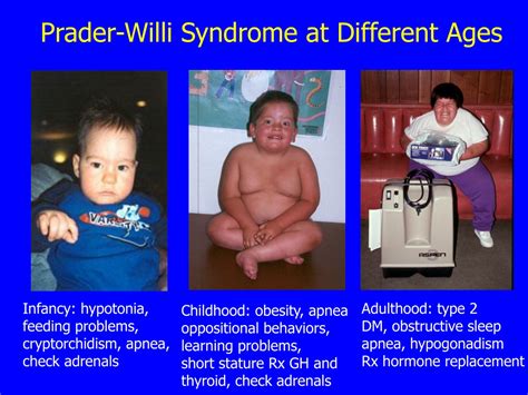 ppt update on medical issues in prader willi syndrome powerpoint presentation id 9309828