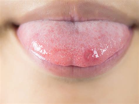Canker Sore On Tongue Pictures Causes And Treatments Medical News Today