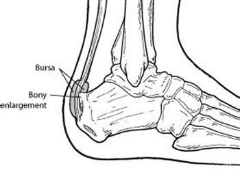 Haglunds Deformity Treatment Podiatrist Foot Doctor Glen Burnie MD