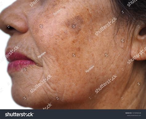 Close Old Woman Face Melasma Freckle Stock Photo 1010958328 Shutterstock