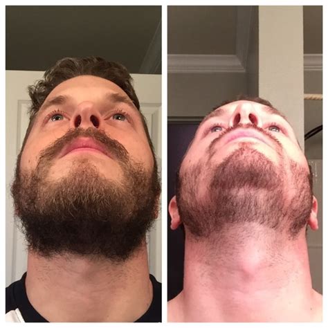 Patchy Beard Success Stories Before And After Photos Page 10 Beard Board