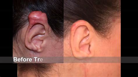 Best Keloid Treatment For Most Difficult Ear Keloid Youtube