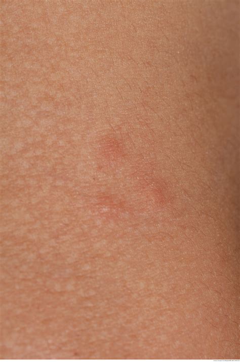Acute Prurigo Simplex In Humans Caused By Pigeon Lice Anais