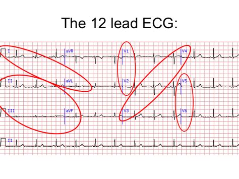 12 Lead Ekg Interpretation And Pharmacology Heartbeat Kenya