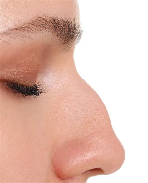Bump On Nose Zenith Cosmetic Clinics