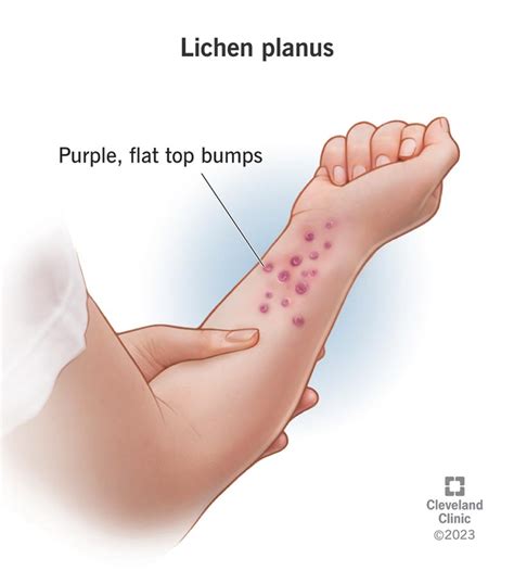Understanding Lichen Planus Causes Symptoms And Treatment Ask The